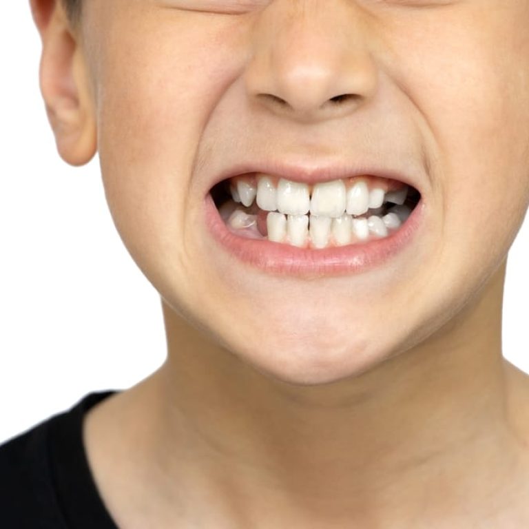 Oral,Health,And,Hygiene.,Boy,Grinding,His,Teeth,On,A