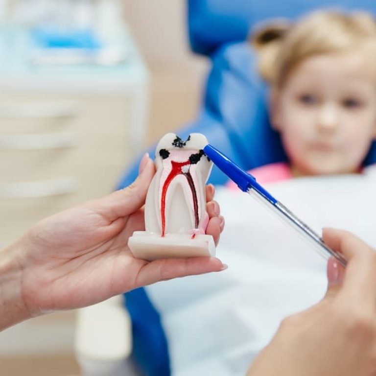 Demonstration,Different,Stages,Caries,On,Tooth,Model,For,Little,Patient