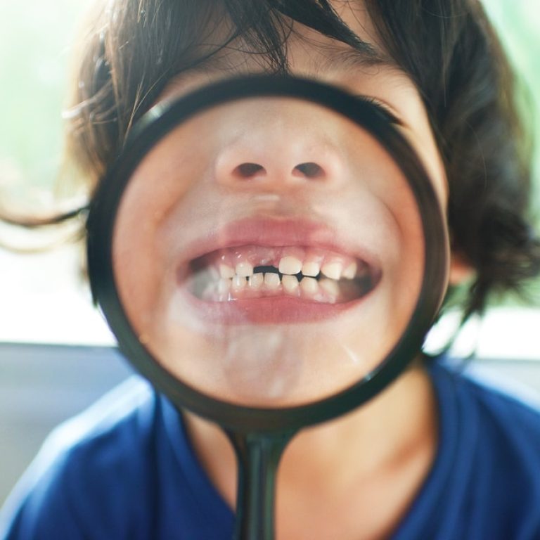 Cute,Funny,Child,Showing,Missing,And,Growing,Tooth.boy's,Milk,Teeth.preschooler